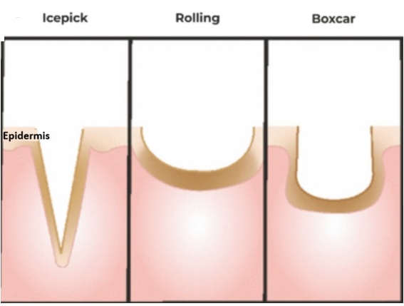 Lipoma